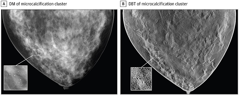 Computer generated mammography